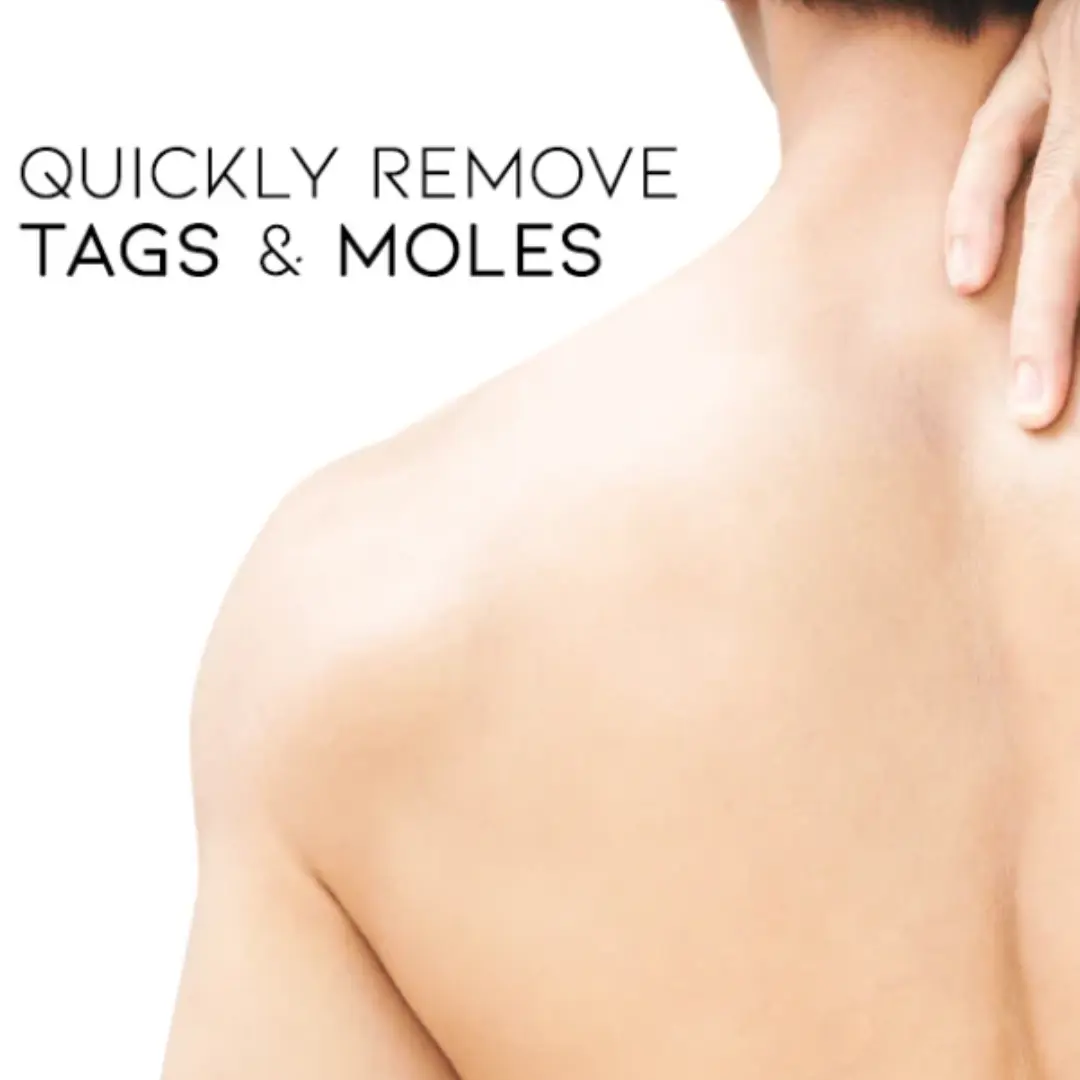 Bee Venom Mole and Wart Treatment Cream - LIMITED-TIME OFFER - Image 8