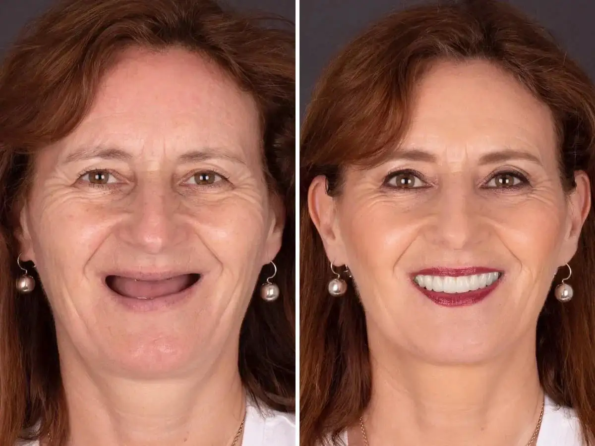 BioFusion Dentures - Image 6