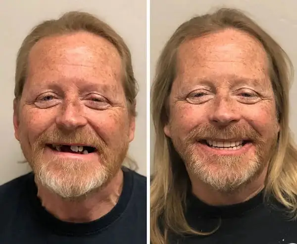 BioFusion Dentures - Image 7