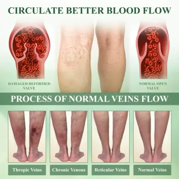 Leg Therapy Edema Cream - Image 6