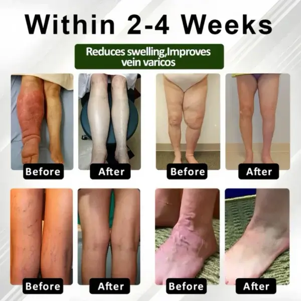 Leg Therapy Edema Cream - Image 3