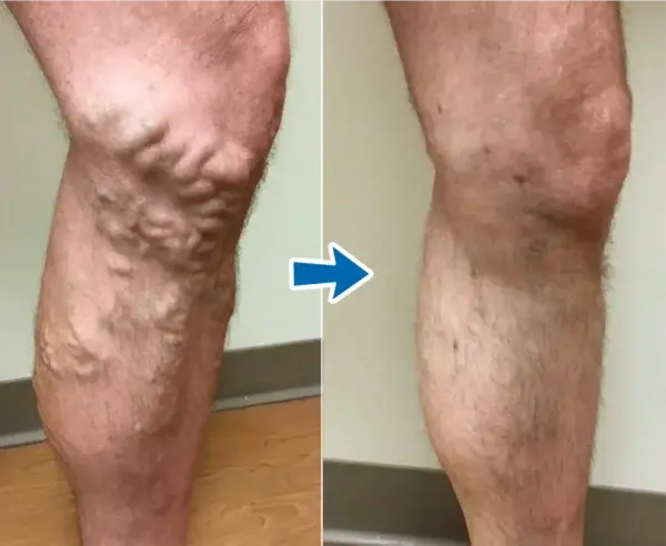 VenoAid Varicose Solution Spray - Image 6