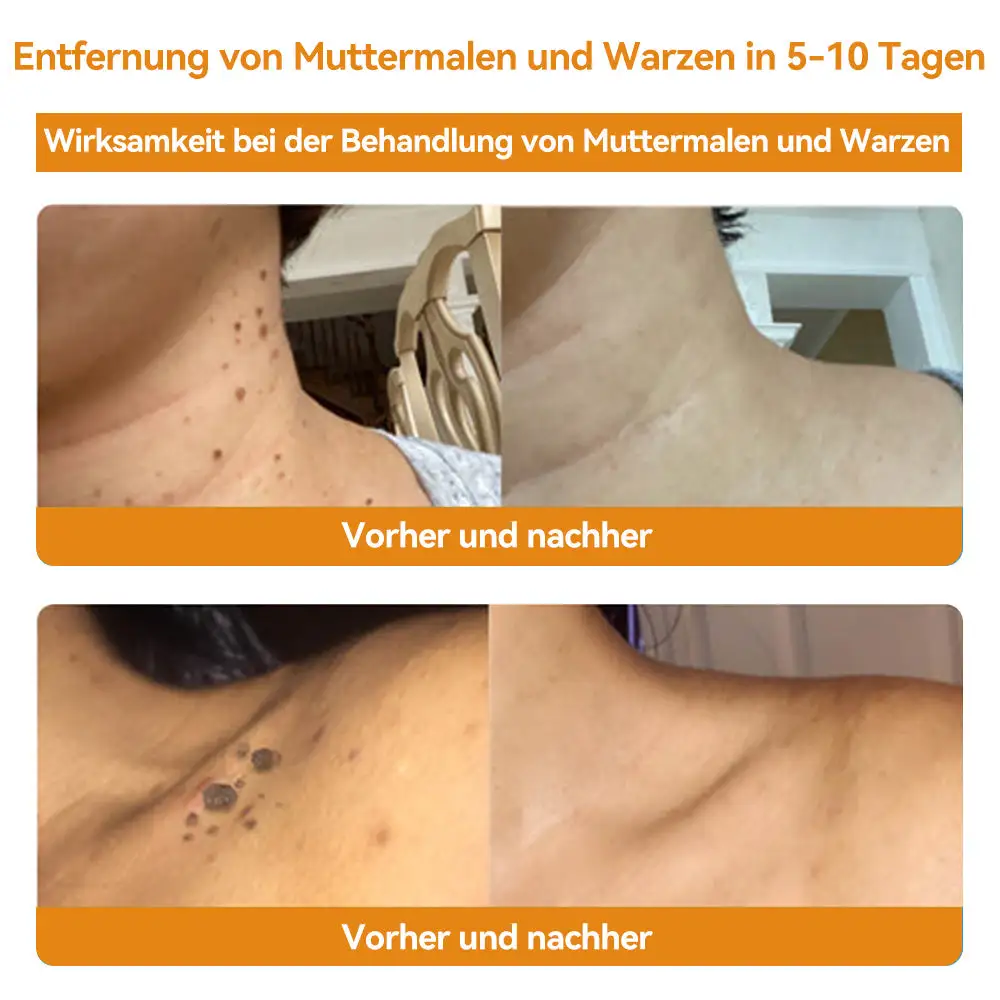 Bienengift Waren & Muttermalenfernung Creme - Image 6