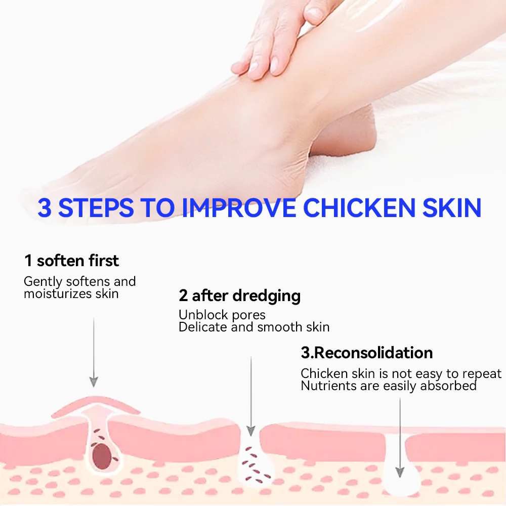 Keratosis Pilaris & Akne Behandlung Körper Erfrischende Creme - Image 4
