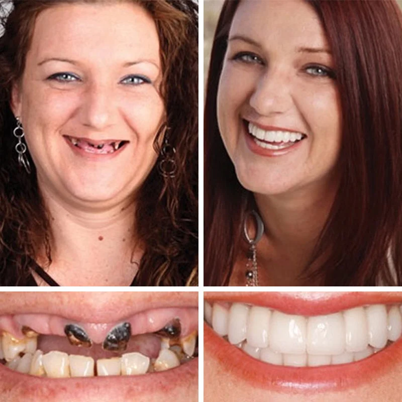 Custom Comfort Dentures - Image 4