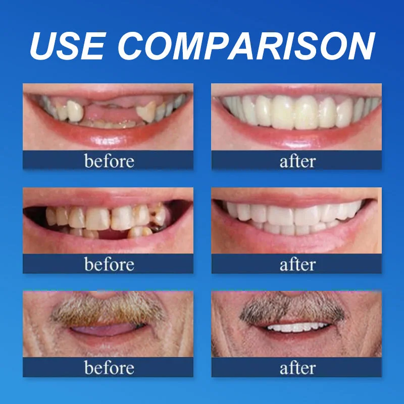 Custom Comfort Dentures - Image 5
