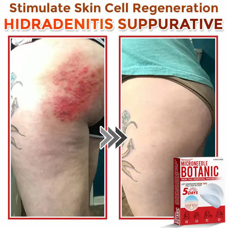 MicroNeedle Botanic Skin Tag Removal Patch - Image 10