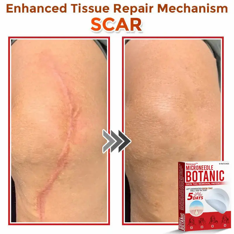 MicroNeedle Botanic Skin Tag Removal Patch - Image 11