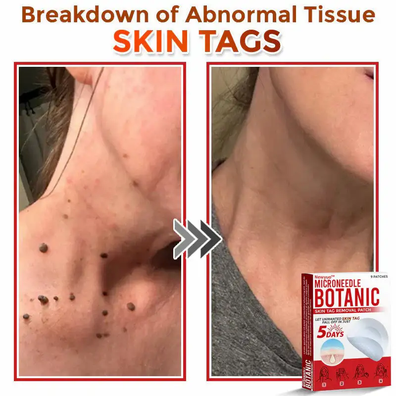 MicroNeedle Botanic Skin Tag Removal Patch - Image 5