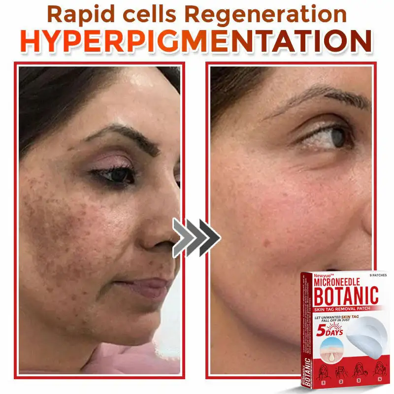 MicroNeedle Botanic Skin Tag Removal Patch - Image 7