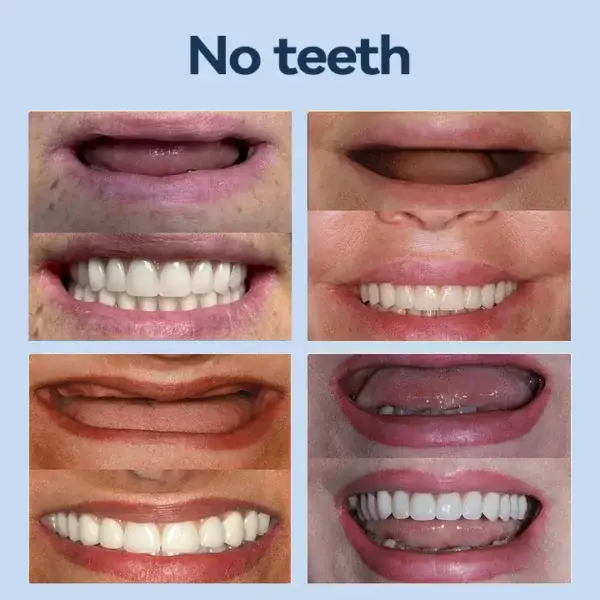 – MedicalFit Adaptive Dentures – Suitable for all mouth shapes perfect fit - Image 9