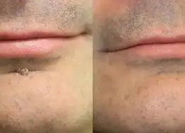 2-in-1 Microneedle & Hydrocolloid Patch - Image 14