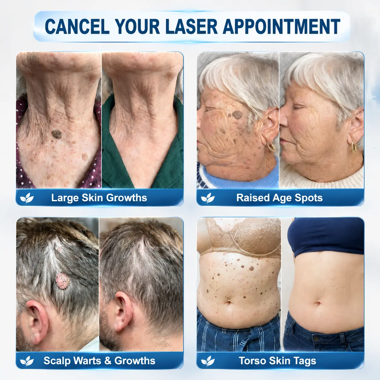 Clinical Wart Removal Patch - Image 2