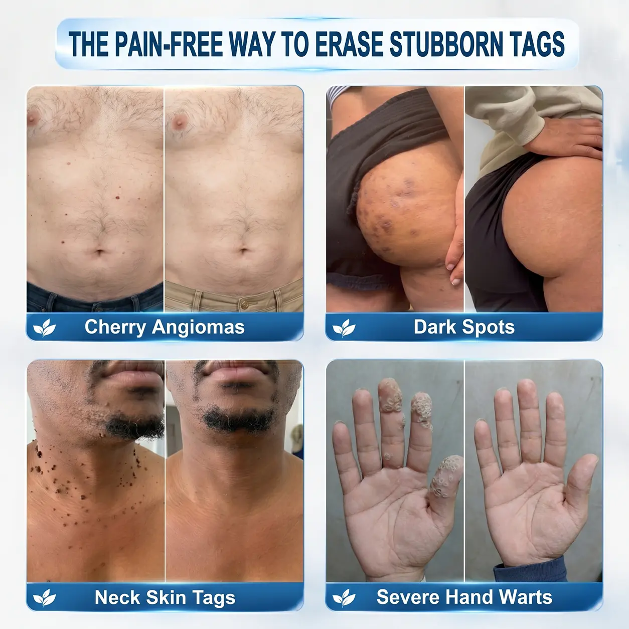 Clinical Wart Removal Patch - Image 3