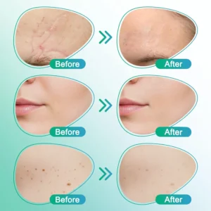 Alternative view of 3-in-1 Scar Removal Microneedle Care Patch