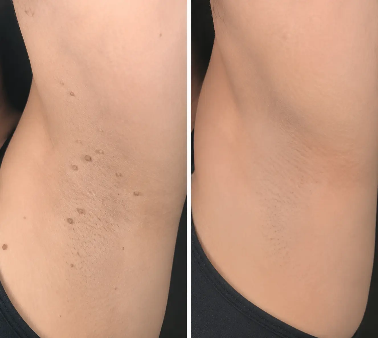 2-in-1 Microneedle & Hydrocolloid Patch - Image 9