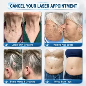 Alternative view of 7-Day Skin Tag & Spot Eraser Painless & Scar-Free Advanced Imperfection Removal Rollerball Pen