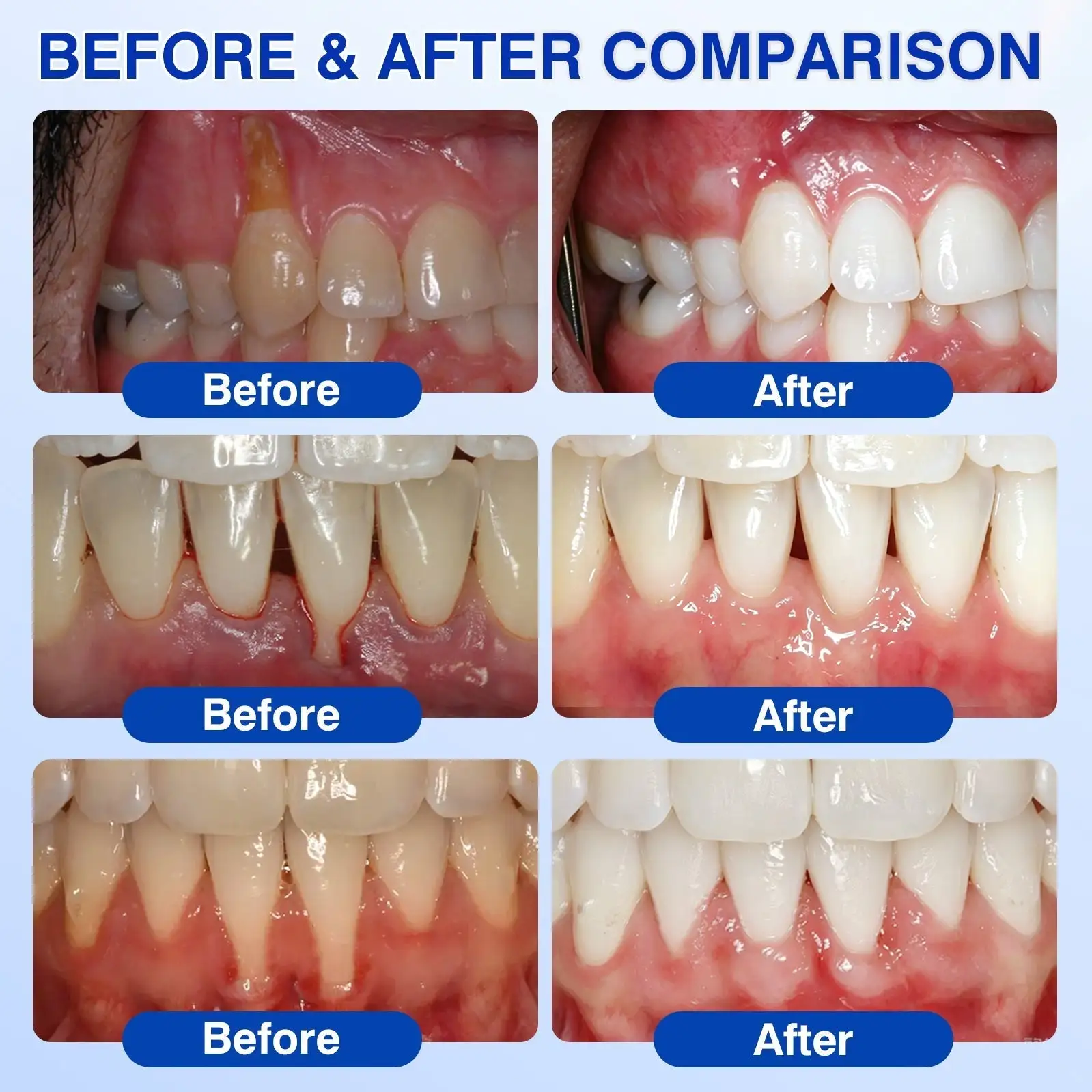 Tiworld ® Gum health Periodontal Repair Gel - Image 2